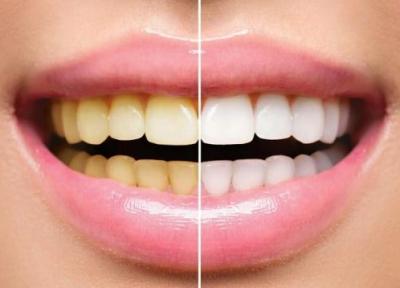 درمان های خانگی یا حرفه ای؛ برای سفید کردن دندان ها کدام روش موثرتر است؟